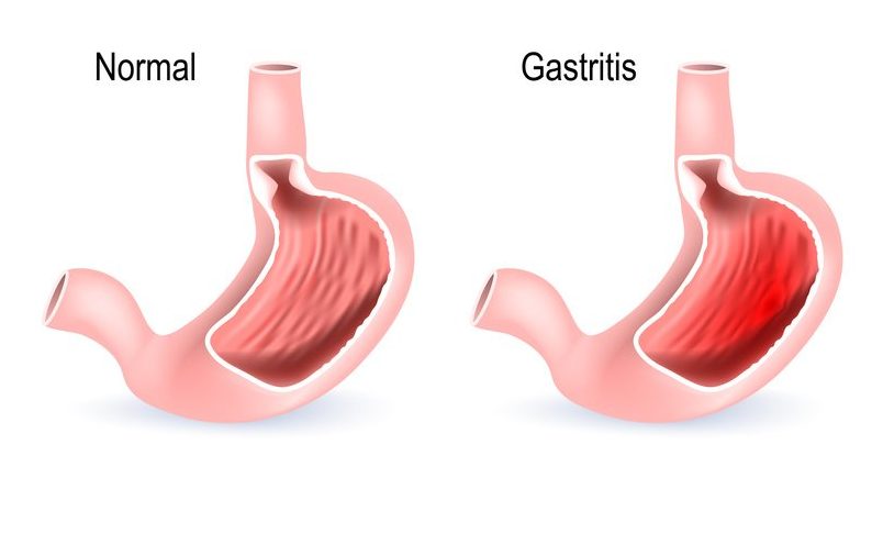 Gastritis