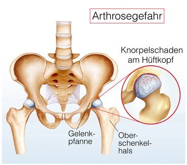 Arthrose als Grund für Hüftgelenksschmerzen