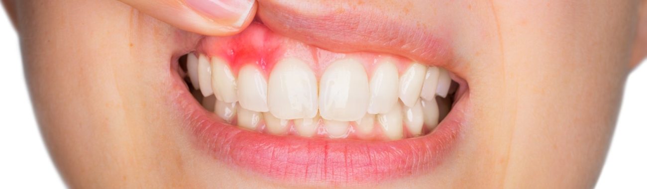 Zahnfleischentzündung: Entzündung im Mund
