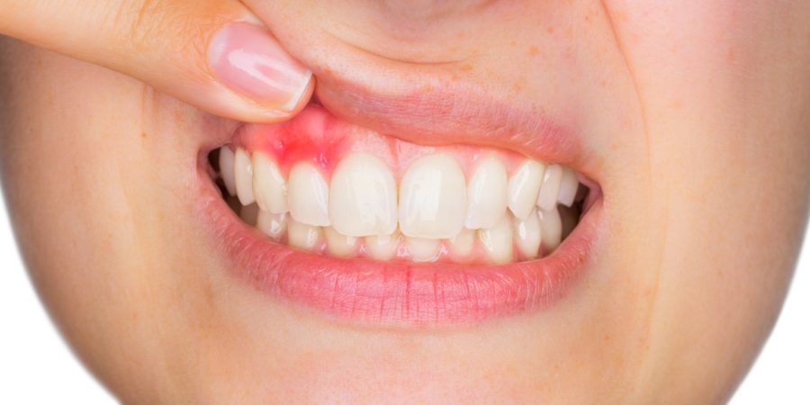 Zahnfleischentzündung: Entzündung im Mund
