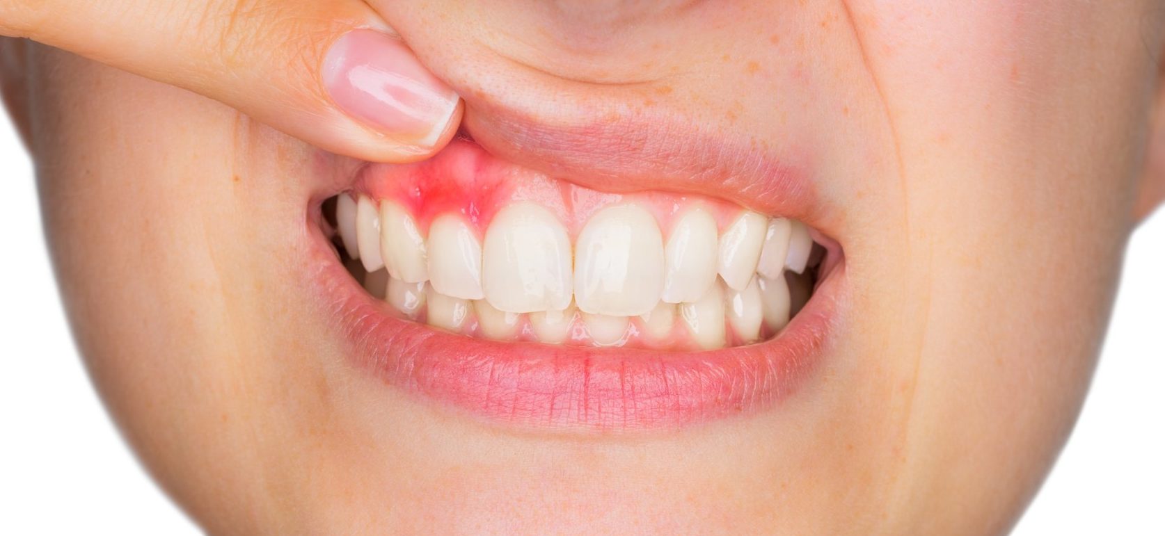 Zahnfleischentzündung: Ursachen & Behandlung von Gingivitis