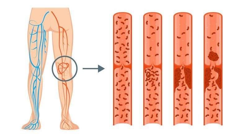 Thrombose: Erklärung