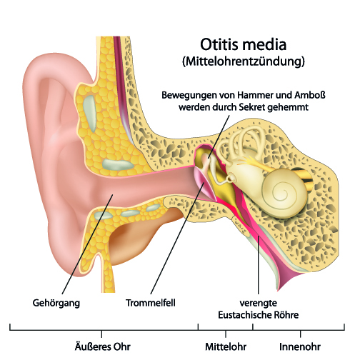 Otitis Media / Mittelohrentzündung durch Bakterien